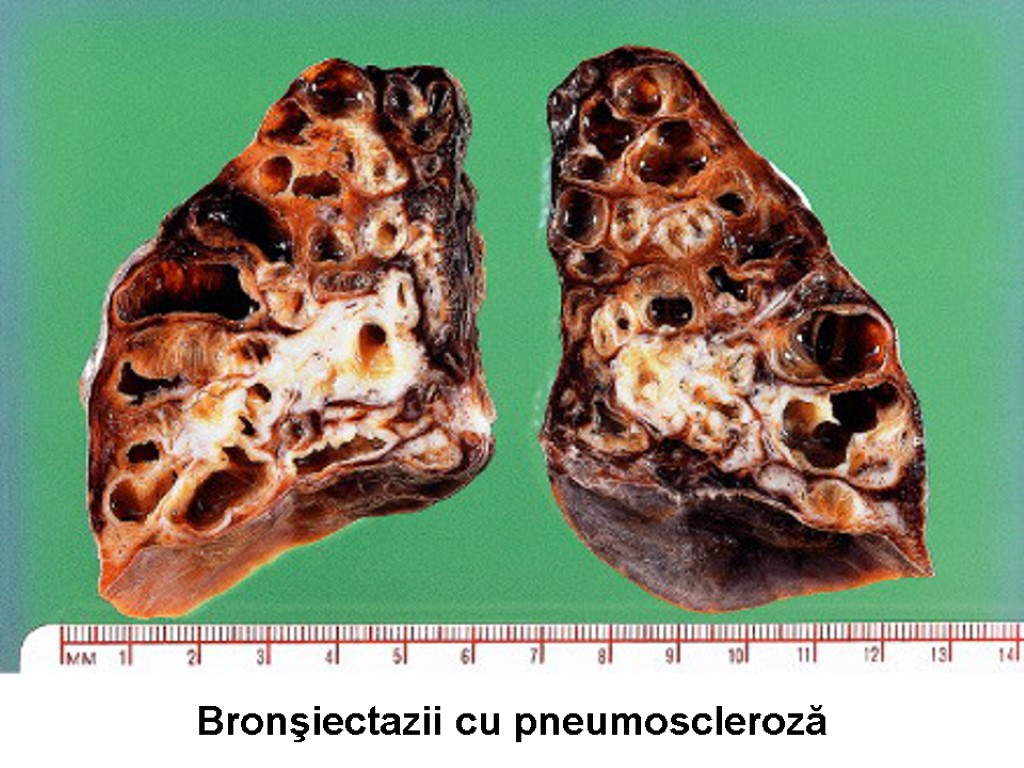 Bronşiectazii cu pneumoscleroză